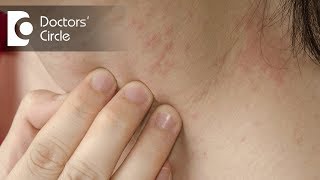 How to identify scabies rash amp its management  Dr Sudheendra Udbalker [upl. by Neeven]