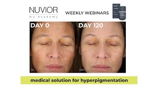 Join us for an exclusive webinar that will transform your approach to hyperpigmentation treatments [upl. by Kciremed]