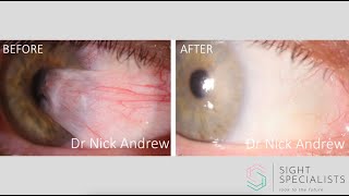 Pterygium surgery explained [upl. by Ynnaffit]