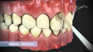 MATRIZ CERVICAL TDV  Restauraciones de Clase V [upl. by Sibylle]