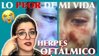 HERPES zoster OFTÁLMICO 👁 Síntomas y tratamiento  MI EXPERIENCIA 😪😭 [upl. by Letty]