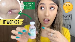 Mario Badescu DRYING LOTION 3 DAYS RESULT  IS IT WORTH IT  SKIN CARE [upl. by Notsahc]