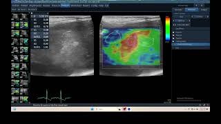 IQ 306 LIVER HEPATOMA ULTRASOUND ECHOPAC ANALYSIS ELASTOGRAPHY 2 [upl. by Argus]