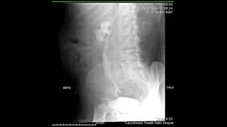 CASE REVIEW intravenous pyelography IVP [upl. by Netfa548]