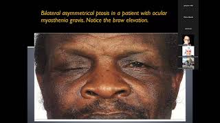 Approach to patient with diplopia [upl. by Niarfe]