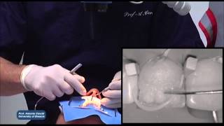 IPS Empress Direct StepbyStep with Prof Antonio Cerutti [upl. by York]