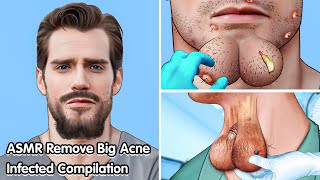 ASMR Remove Big acne Dogtick Infected Compilation  Deep Cleaning Animation [upl. by Akived]