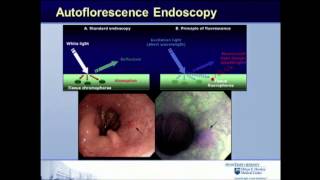 Classification and imaging in Barretts esophagus  Endoscopic Management of GEJ Disease [upl. by Terle]