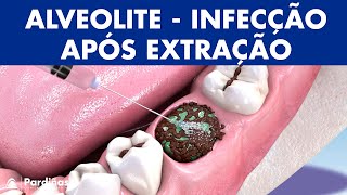 ALVEOLITE  Infecção após extração dente causas e tratamento © [upl. by Oliviero]