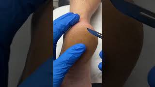 Thick Heel Callus Removal by Australian Podiatrist  Effective Treatment for Calluses and Corns [upl. by Jansen52]