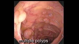 Colonoscopy FollowUp of Colon Polyp  Los Angeles Colonoscopy [upl. by Johathan]