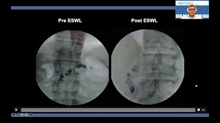 Endotherapy of panceatic stones after ESWL by spyglass laserlithotripsy Amit Maydeo [upl. by Oinimreh364]