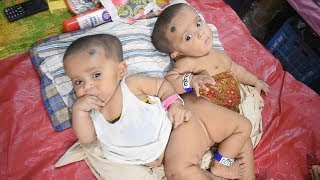 Bangladeshs conjoined twins to undergo separation surgery [upl. by Dde116]