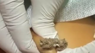 Big Cystic Acne Blackheads Extraction Blackheads amp Milia Whiteheads Removal Pimple Popping [upl. by Benilda791]