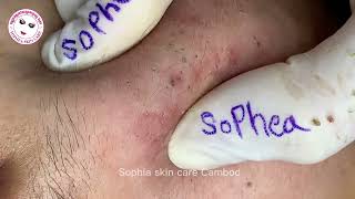 Acne facial removal treatment by Sopheaskincarecambodia 24th February 2024 [upl. by Ahse]