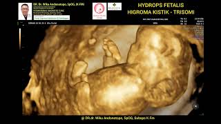 Hygroma Kistik  Hydrops Fetalis 12 Weeks  Trisomi [upl. by Nibla]