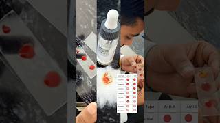 Blood Group Test  Hematology  MBBS medical practical bloodgrouptest physiology pathology [upl. by Schlosser]