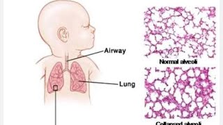 infant Respiratory Distress Syndrome RDS  Hyaline Membrane Disease [upl. by Leah579]