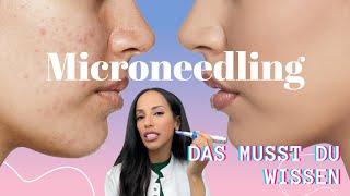 Microneedling  ALLES WAS DU WISSEN MUSST [upl. by Lavella]