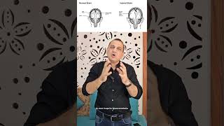 सिर में यह गैप कैसे आ गया Post Craniectomy Bone Defect NeuroMedTalks01 neurosurgeon brain [upl. by Fabrice898]