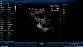 Dichorionic twins and two corpus luteum cysts Diagnostic ultrasound cases [upl. by Nylrehc198]