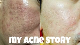 My Acne Story Fractional CO2 amp Derma Roller ACNE SCARS [upl. by Erialcyram426]