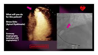 Stress Echo vs Coronary Angiography Apical Dyskinesia vs Previous LAD Angioplasty [upl. by Niroht371]