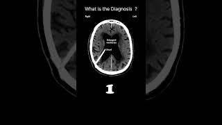 Medical artifact CT brain Acute CT Brain Brain CT quality and artifacts 42 radiologychannel007 [upl. by Rebmik187]