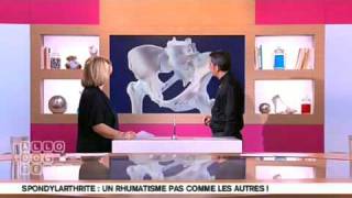 Présentation de la Spondylarthrite Ankylosante [upl. by Yleik]