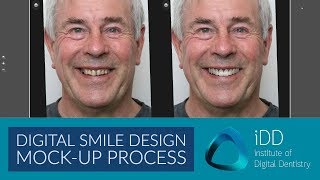 Digital Smile Design Mockup Demonstration [upl. by Refinnaj]