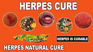 Herpes Cure 2017  Breakthrough Herpes Cure Found  Massive News For Herpes Patients [upl. by Timothy]