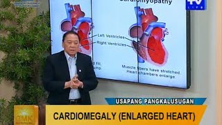 Good Morning Kuya Cardiomegaly Enlarged Heart [upl. by Rambert430]