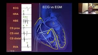 From Surface ECG to Intracardiac EGM Part 1 [upl. by Ruberta960]