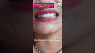 Dental bridgedental crown placementdental care shortfeed dentist dentalbridge oraismilezone [upl. by Matthias]