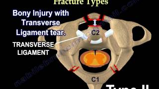 Cervical Spine Injuries Jefferson Fracture  Everything You Need To Know  Dr Nabil Ebraheim [upl. by Adaval]