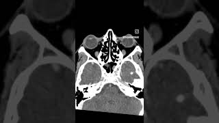 Case9 cect paranasal sinuses viral trending likesforlike commentsforcomments radiology [upl. by Trstram]