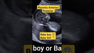 Babyboy or Babygirl 😨Placenta Anterior Placenta Posterior🤗 shorts shortvideo shortsfeed short [upl. by Sairtemed]