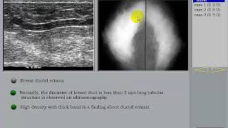 Breast Ultrasound Part 3 Mammary Duct Ectasia [upl. by Ruel397]