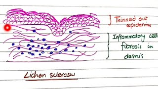 Lichen Sclerosus And Lichen Simplex Chronicus  Pathology [upl. by Yobybab]