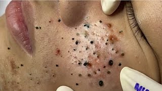 Big Cystic Acne Blackheads Extraction Blackheads amp Milia Whiteheads Removal Pimple Popping  7041 [upl. by Akimad]