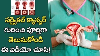 What is Cervical Cancer   Cervical Cancer Causes Diagnosis and Symptoms  Y5 Tv [upl. by Hamner582]