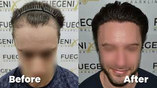 Failed Temple and Hairline Repaired in One Sitting  Hair Transplant  Dr Munib Ahmad  FueGenix [upl. by Adlihtam]