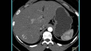 Abdomen Liver Hemangioma of the Liver1 of 8 [upl. by Lu]