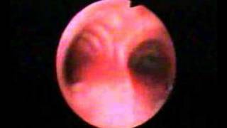 Bronchoscopic Video Clips  Dr PN Agrawal  Bhopal [upl. by Wyne]