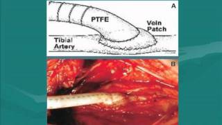 Surgical Approaches for Peripheral Arterial Disease PAD [upl. by Treblig]