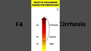 What is the danger range for FibroScan  Fibroscan  Liver Fibrosis Treatment viral hepatitis [upl. by Annodal711]