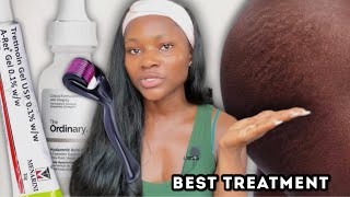 The best treatment for stretch marks ever  How to clear stretch marks fast at home stretchmarks [upl. by Wisnicki785]