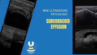 Subcoracoid effusion demonstrated on shoulder ultrasound [upl. by Cimbura804]