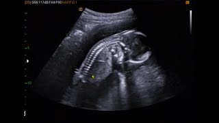 fetal ultrasound of 16 weeks 17 weeks baby boy moving [upl. by Gluck]