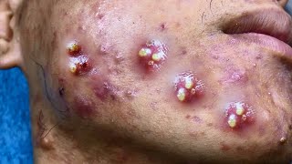 Big Cystic Acne Blackheads Extraction Blackheads amp Milia Whiteheads Removal Pimple Popping [upl. by Amis258]